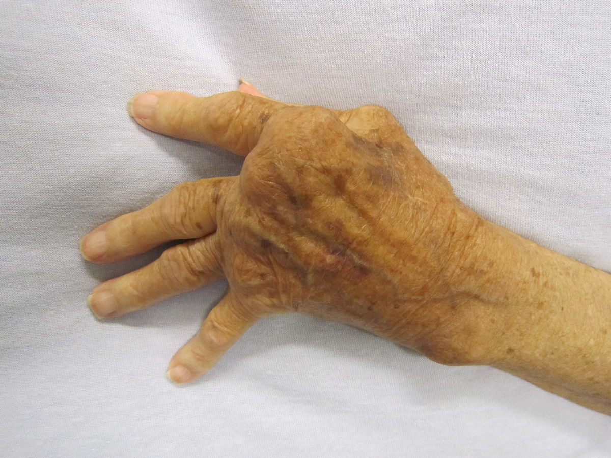 1200px-Rheumatoid_Arthritis
